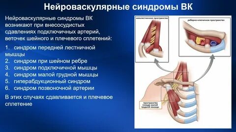Нервно мышечный синдром