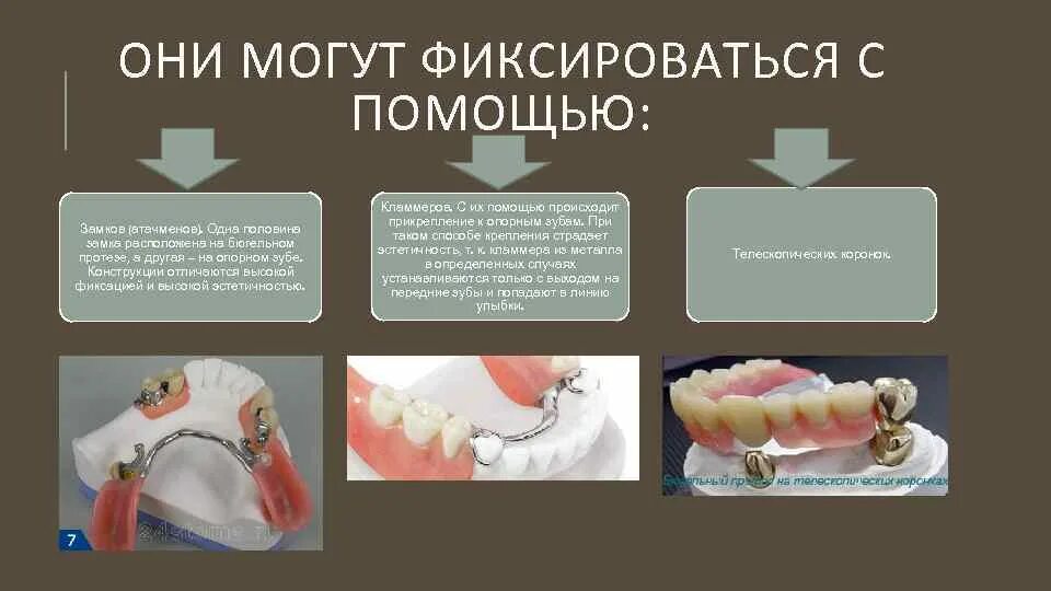 Этапы изготовления бюгельных. Этапы моделирования бюгельного протеза. Кламмер строение бюгель. Классификация кламмеров бюгельного протеза. Элементы замкового крепления бюгельного протеза.