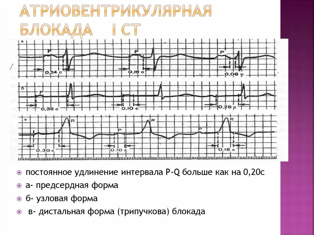 Полная атриовентрикулярная блокада. ЭКГ Холтер АВ блокада. Предсердно-желудочковая блокада ЭКГ. АВ блокада 4 степени на ЭКГ. Неполная АВ блокада 1 степени.