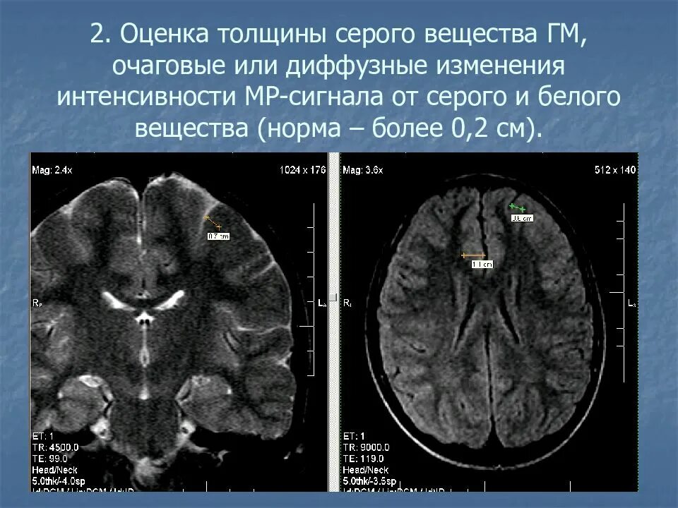 Серое вещество головного мозга на кт. Серое и белое вещество мозга на мрт. Белое и серое вещество головного мозга мрт. Диффузные изменения головного мозга на мрт. Очаговые изменения желудочка