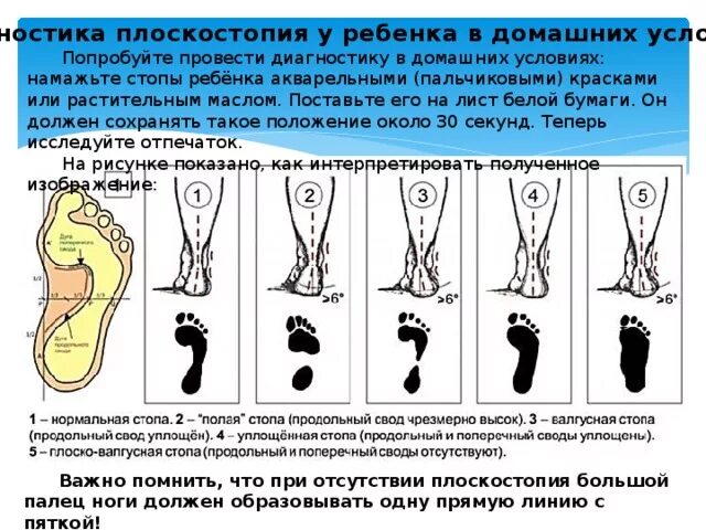 Плоскостопие поперечного свода стопы. Выявление плоскостопия у детей. Самодиагностика плоскостопия. Метод выявления плоскостопия. Продольный поперечный свод