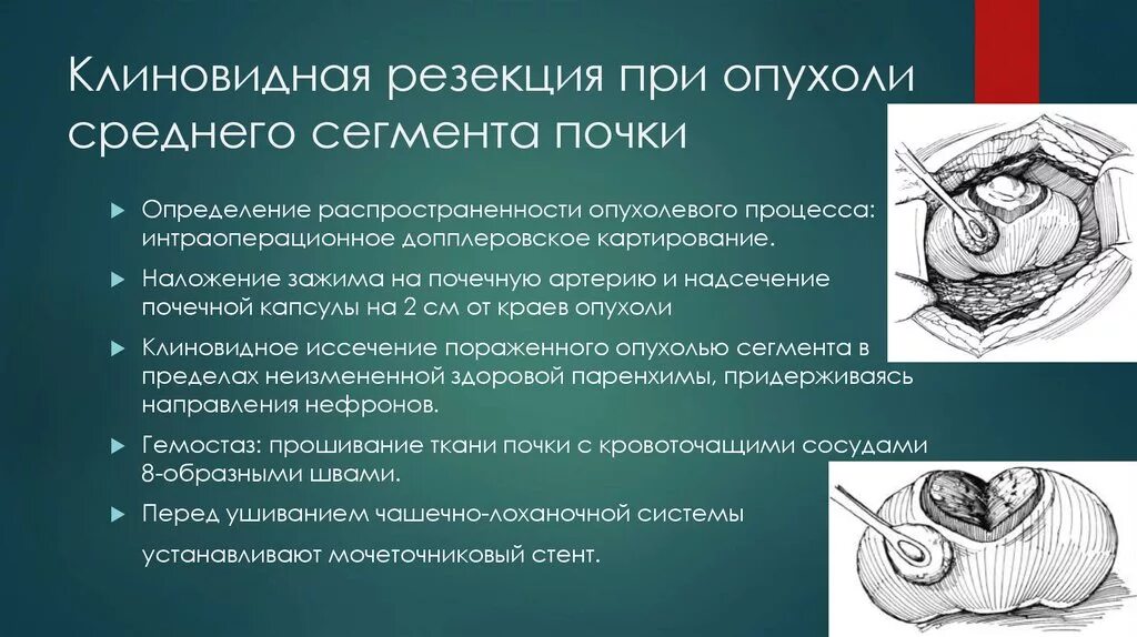 Резекция почки что это. Клиновидная резекция почки. Клиновидная резекция яичника. Клиновидная резекция опухоли почки. Клиновидная резекция яичников алгоритм.