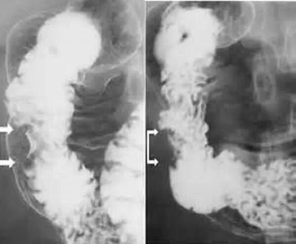 Симптомы рака кишки. Полипоз ободочной кишки рентген. Стеноз Толстого кишечника рентген. Стеноз тонкой кишки рентген. Непроходимость двенадцатиперстной кишки рентген.