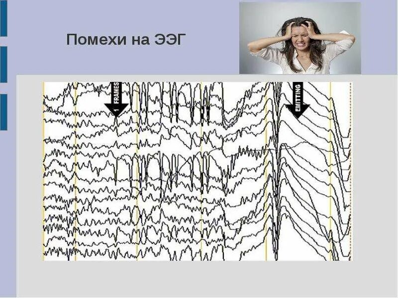 Записаться на ээг. Помехи на ЭЭГ. Артефакты ЭЭГ. Сетевая наводка на ЭЭГ. ЭЭГ запись.