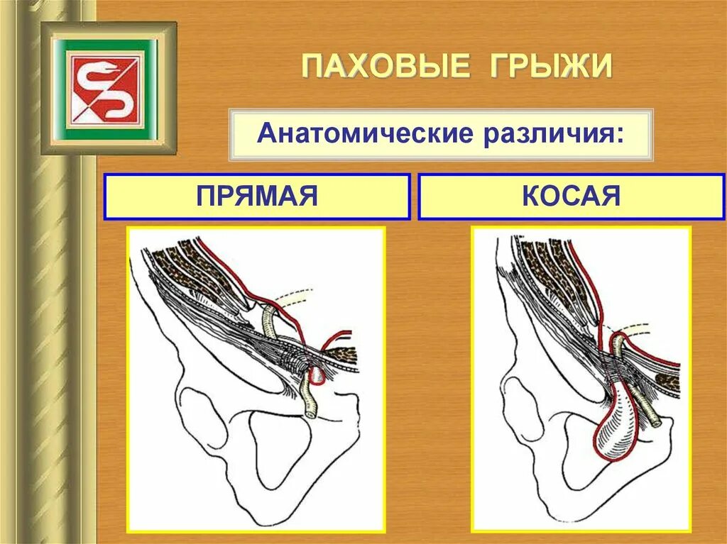 Как отличить паховую