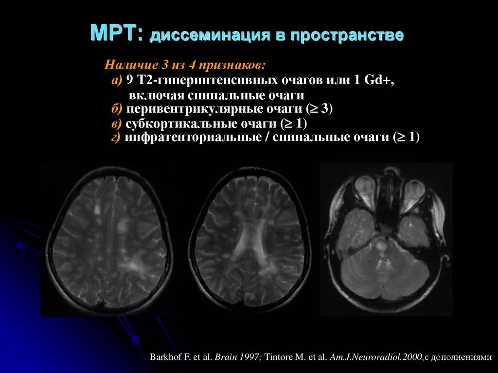 Единичный очаг в левой лобной доле. Рассеянный склероз очаги мрт. Перивентрикулярный очаг мрт. Инфратенториальные очаги. Субкортикальные очаги головного мозга.