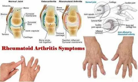 Polyarthritis латынь