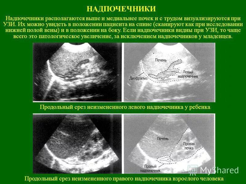 норма надпочечников по узи. ультразвуковая анатомия надпочечников. узи надпочечников как делают. надпочечники при узи. узи надпочечников.