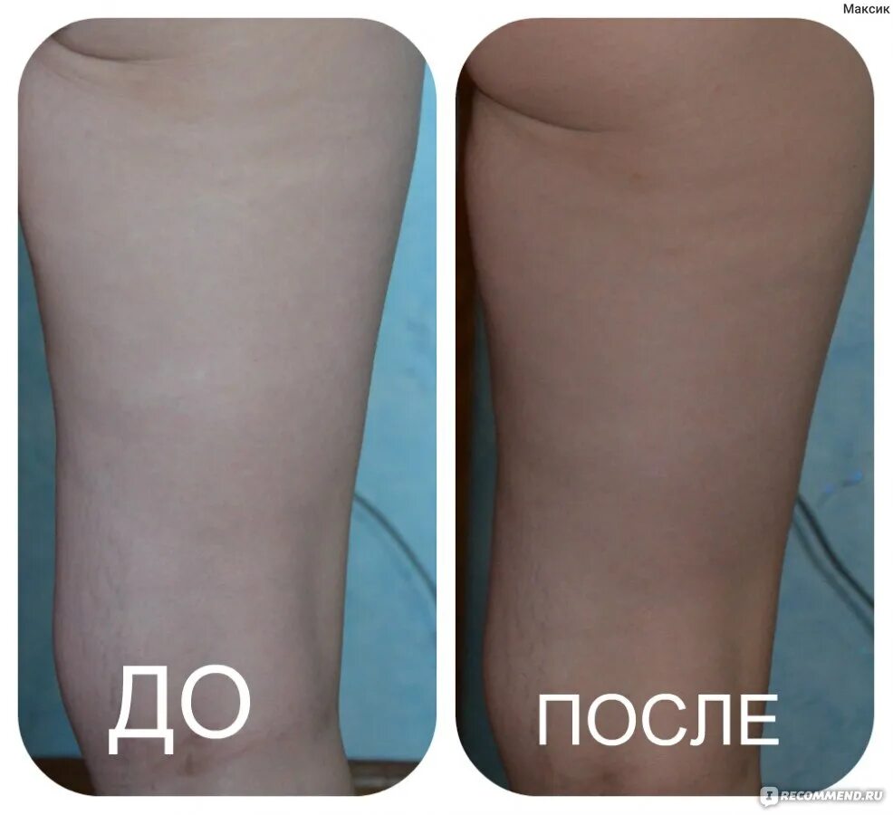 Обертывание живота до и после. Результаты похудения. Обертывание до и после. Обертывание до и после. Обертывание до и после.