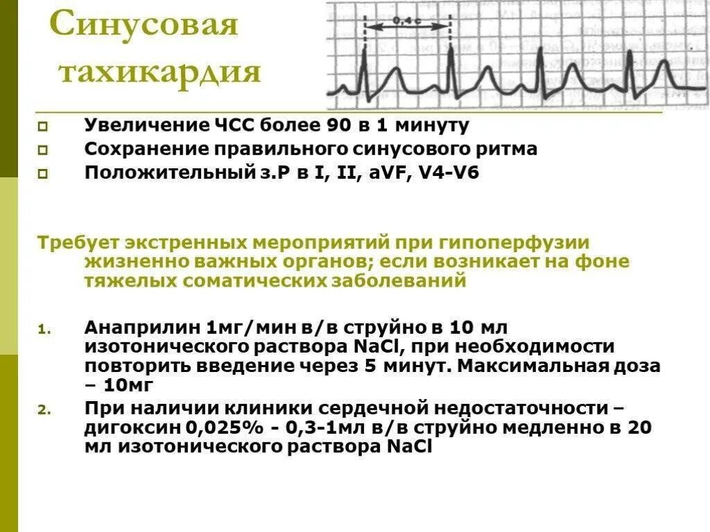 При учащении пульса длительность сердечного цикла. ЭКГ проявления синусовой тахикардии. Синусовая тахикардия (110 уд/мин). Транзиторная синусовая тахикардия. Синусовая тахикардия ЧСС 106.