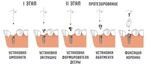 Зуба этапы