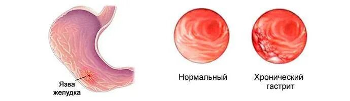 Язва и армия. Здоровый желудок и гастрит. Язвенная болезнь армия. Хронический гастрит армия.