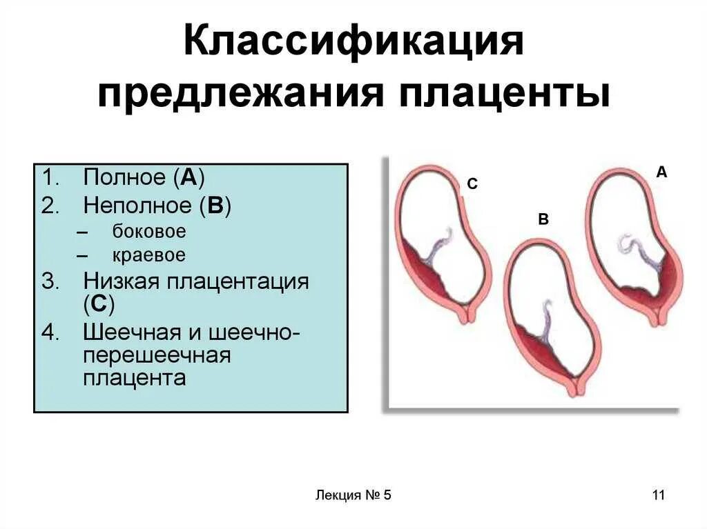 Краевое боковое центральное низкое предлежание плаценты. Диагностические критерии предлежание плаценты. Шеечно-перешеечной предлежание плаценты. 5. Классификация предлежания плаценты.. При низкой плацентации можно