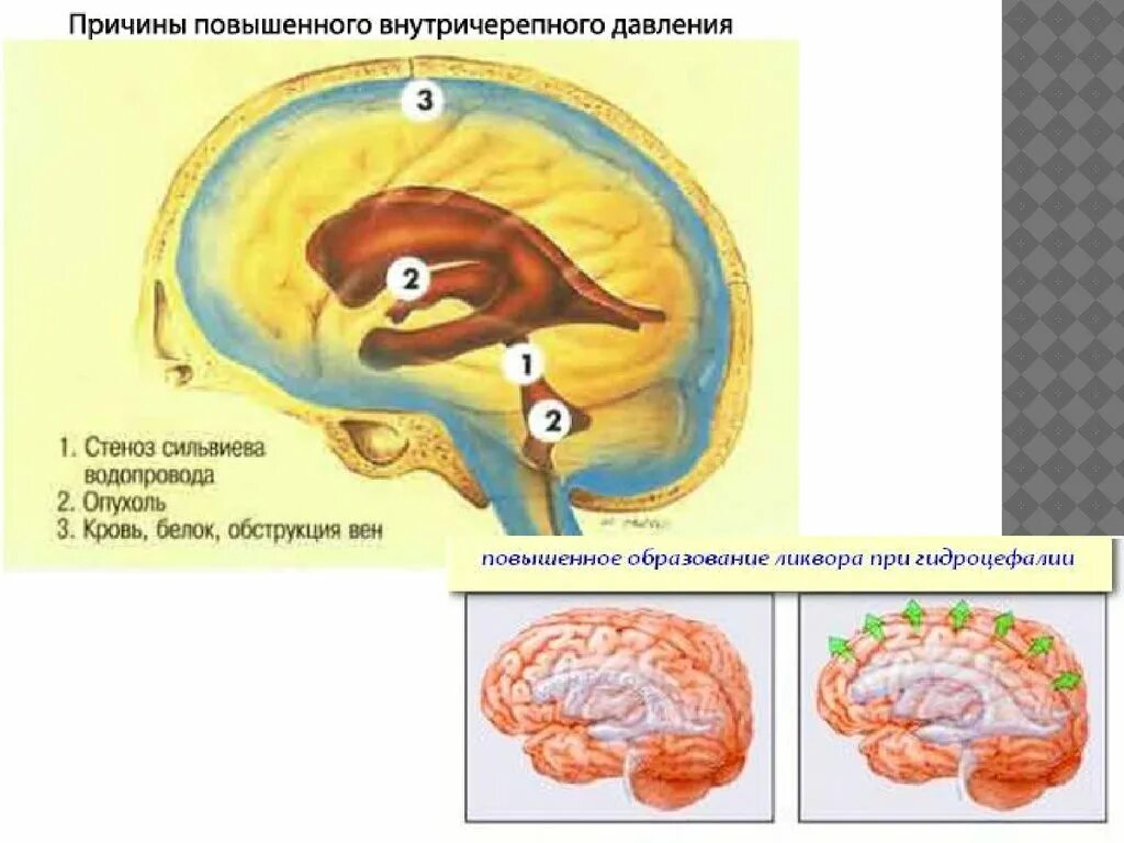 Внутричерепное давление. Причины повышения внутричерепного давления. Внутреннее черепное давление. Высокое черепное давление.