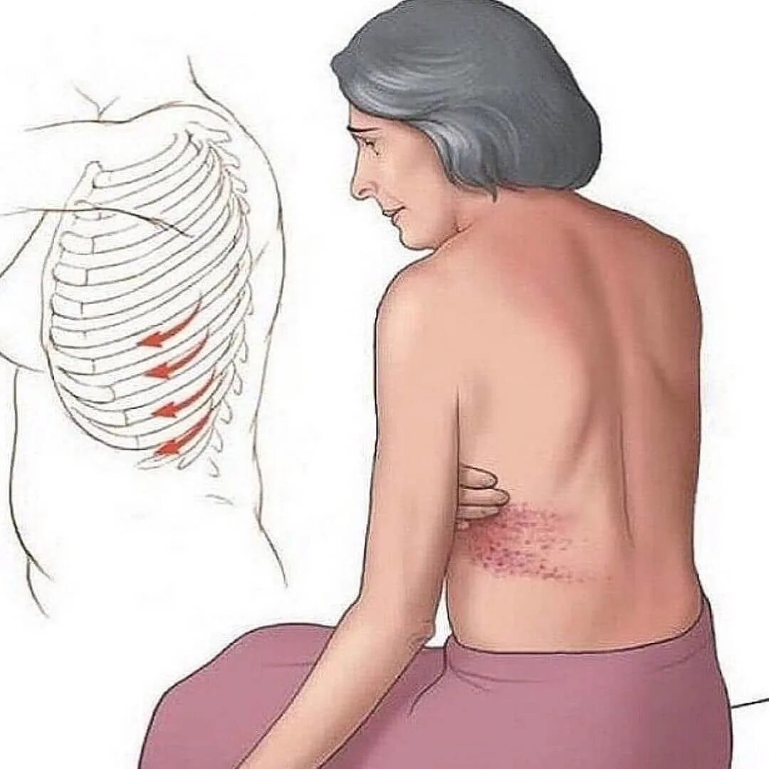 Боли поясницы при колите. Опоясывающий лишай межреберная невралгия. Herpes zoster (опоясывающий лишай). Опоясывающий герпес межреберный. Герпес зостер межреберная невралгия.