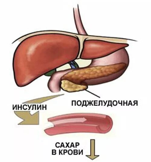 Пересадка поджелудочной при диабете. Поджелудочная железа диабет 1 типа. Сахарный диабет 1 типа поджелудочная железа. Поджелудочная железа с диабетом 2 типа. Поджелудочная железа сахарный диабет 2 типа.