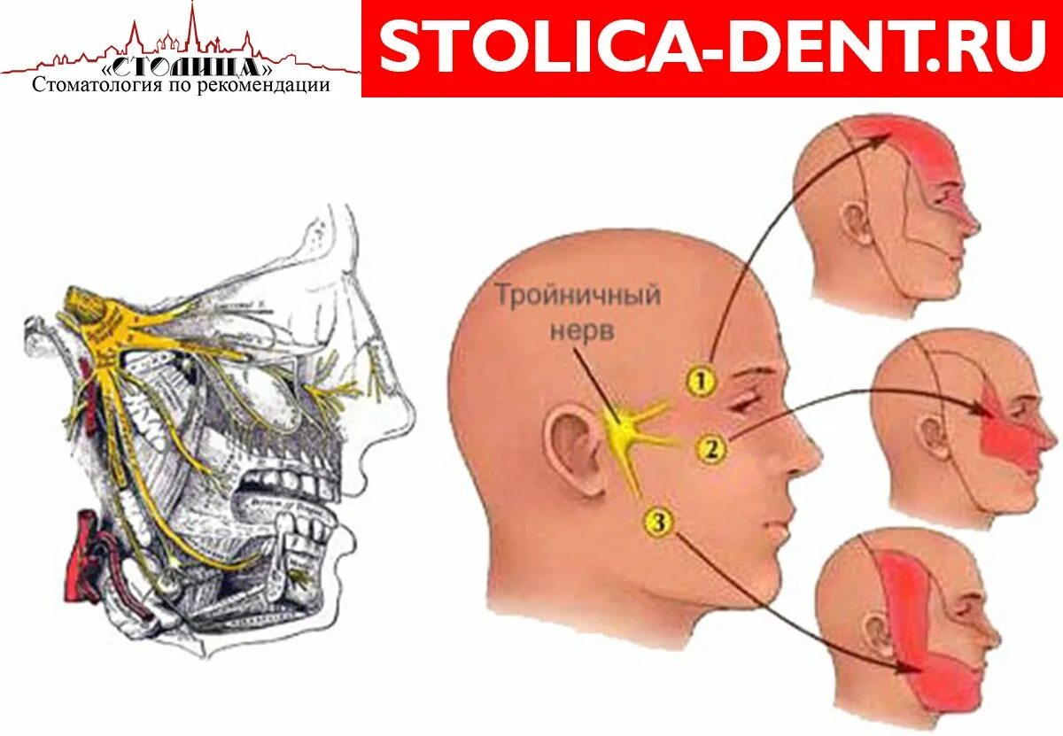 Лицевой нерв челюсти. Невралгия тройничного нерва 1. Воспаление тройничного лицевого нерва. Поражение ветвей тройничного нерва. Воспаление верхней ветви тройничного нерва.
