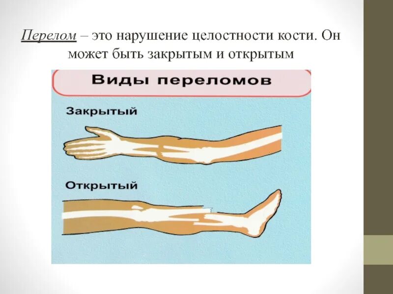 Закрытый перелом это. Травмы опорно двигательной системы. переломы опорно двигательного аппарата. травмы опорно-двигательного аппарата перелом.