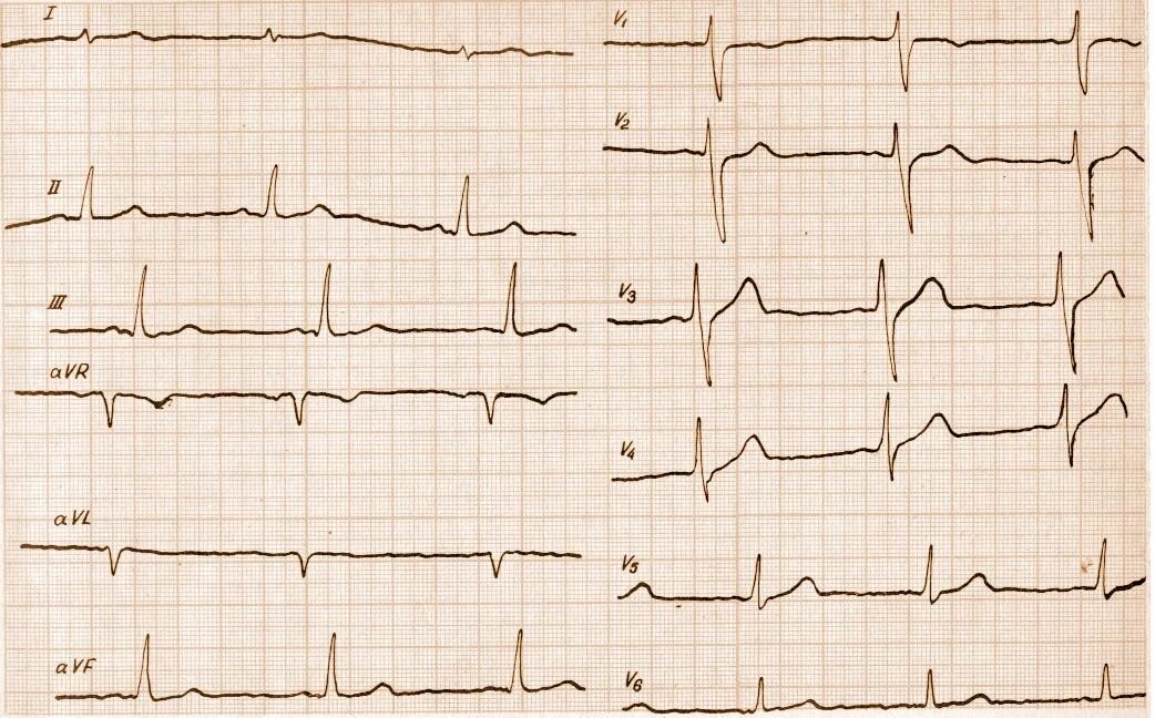 Вертикальная позиция сердца. ЭОС вертикальная на ЭКГ что это. Брадикардия на ЭКГ. ЭКГ при вертикальной ЭОС. Вертикальная ЭОС сердца на ЭКГ что это.