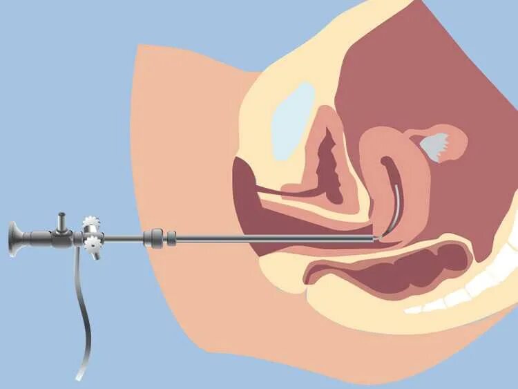 Выскабливание полости матки гистероскопия. Полип эндометрия гистероскопия. Гистероскопия полипэктомия. Гистерорезектоскопия полипа эндометрия. Гистероскопическая миомэктомия.