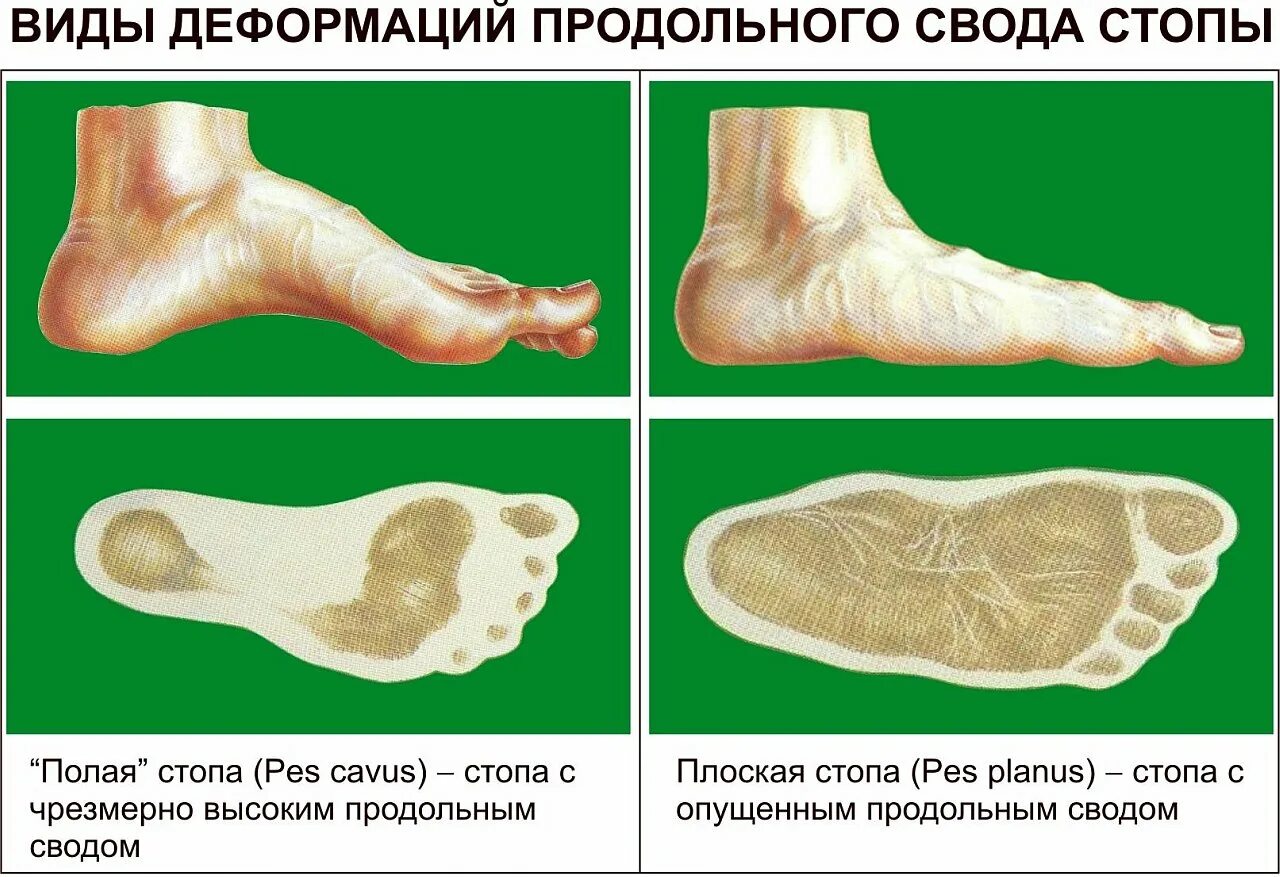 Продольный и поперечный свод стопы. Плоскостопие поперечного свода стопы. Продольный свод стопы плоскостопие. Свод стопы плоскостопие анатомия.