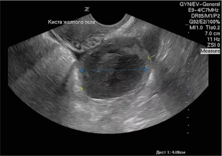 Геморрагическая киста яичника на УЗИ. Киста желтого тела яичников. Фолликулярная киста желтого тела. Киста желтого тела левого яичника с кровотоком.