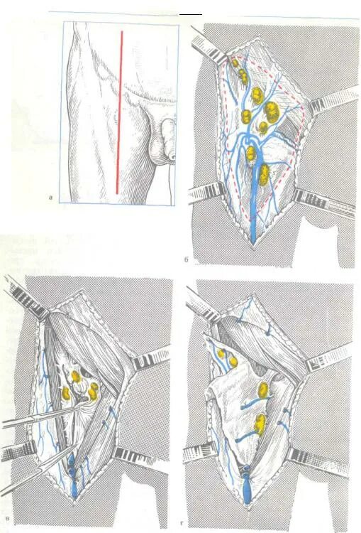 Лимфаденэктомия это. Пахово-бедренная лимфаденэктомия. Пахово-подвздошная лимфаденэктомия операция Дюкена. Операция Дюкена техника операции. Операция Дюкена Мельникова.