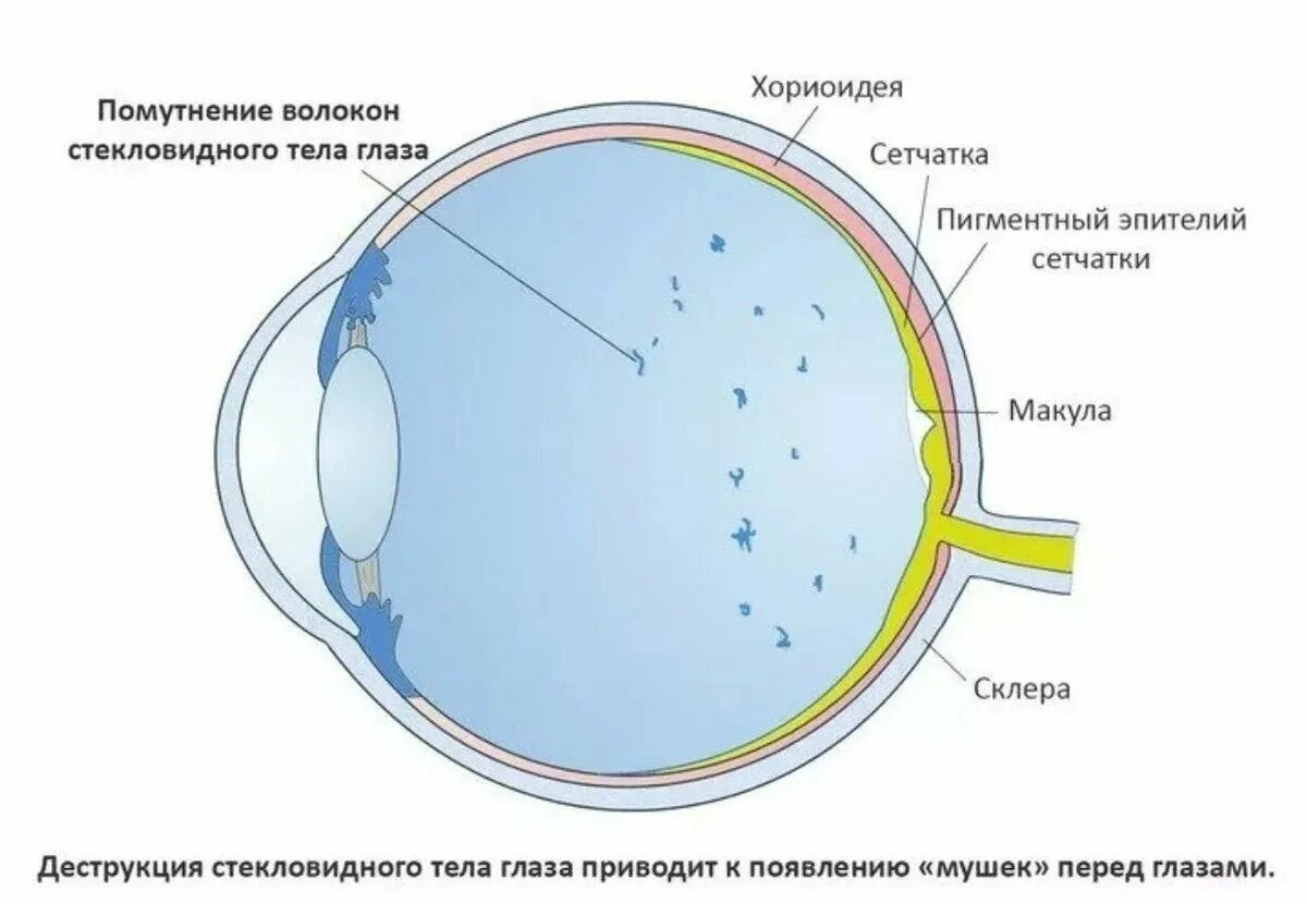 Почему в глазу вода. Деструкция стекловидного тела глаза. Диструктив стеклоаидного тела глаза. Де трукция стекловидного тела. Деструкция световмдного тела.