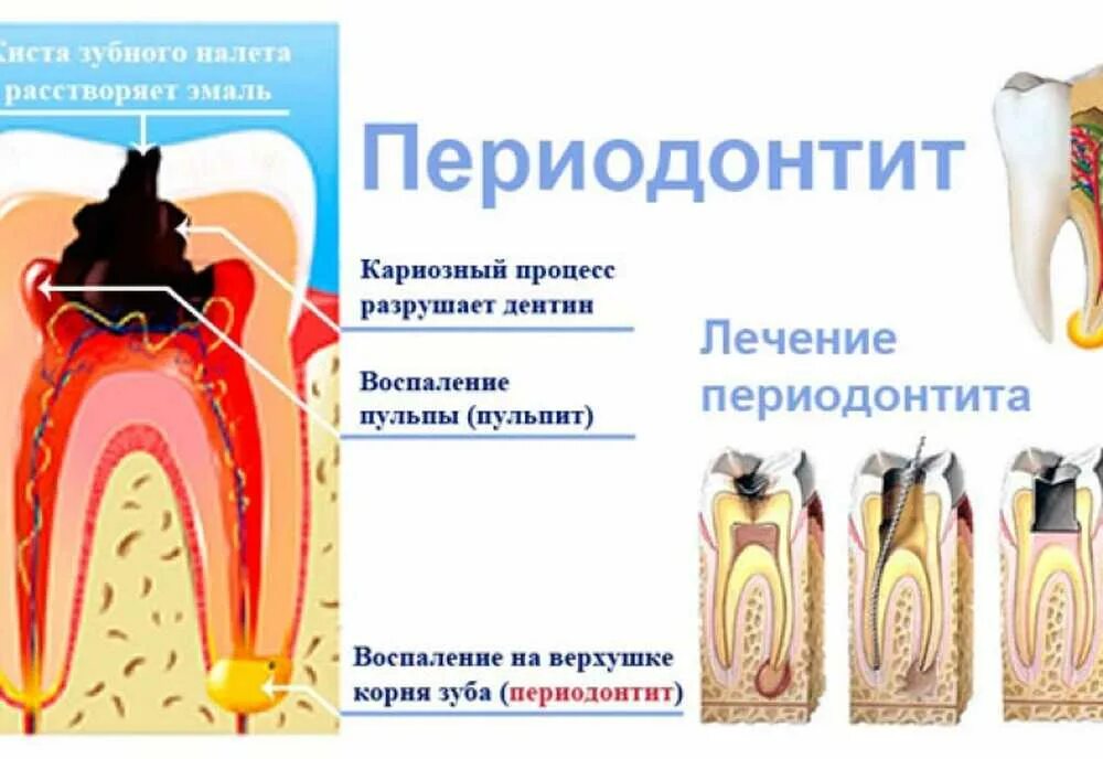 Периодонтит 3 корневого зуба. Хронический периодонтит передних зубов. Воспаление апикального периодонтита. Этапы кариеса пульпита. Осложнение лечения периодонтита