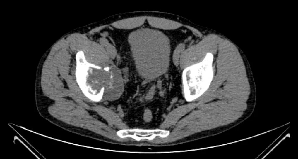 Кт подвздошной кости. Саркома подвздошной кости кт. Остеосаркома подвздошной кости на кт. Остеосаркома тазобедренного сустава кт. Саркома мягких тканей кт.