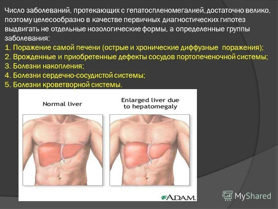 Гепатомегалия симптомы и лечение. Синдром гепатоспленомегалии. Клинические проявления гепатоспленомегалии.