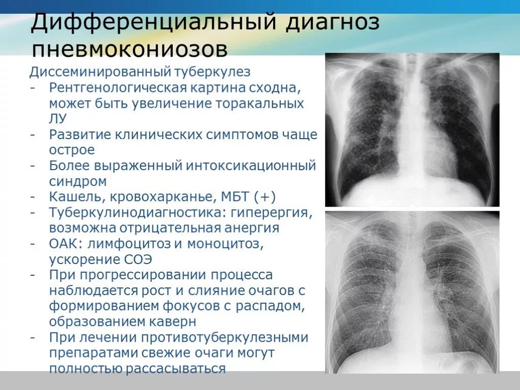 Диссеминированный туберкулез фаза инфильтрации