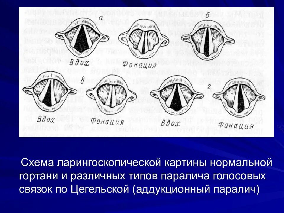 На рисунке изображены различные положения голосовых связок. Парезы и параличи голосовых связок. Паралич голосовых складок.