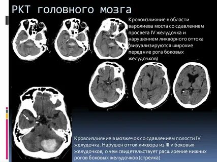 Задний рог правого желудочка
