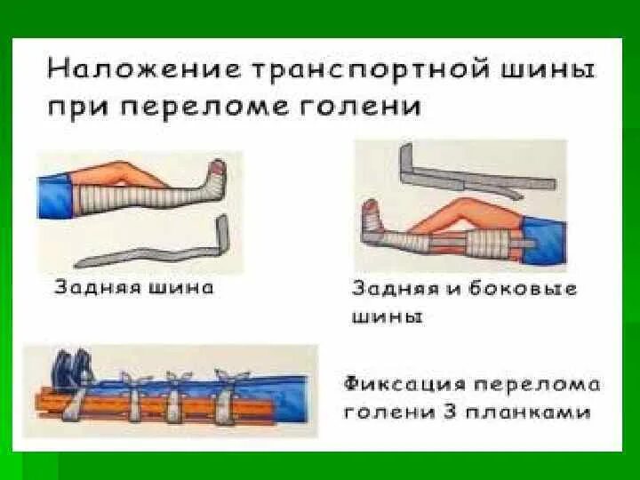 При открытом переломе накладывают. Наложение транспортных шин при переломах. Наложение шины при переломе. Наложение шины при переломе голени. Наложить шину при переломе.