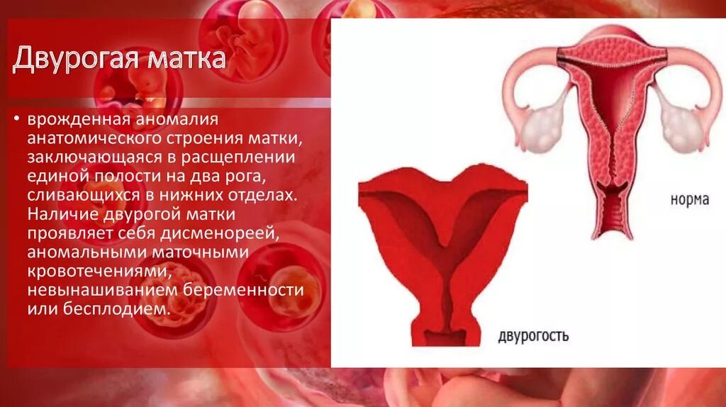 аномалия развития матки двурогая матка. двурогая седловидная матка. двурогая форма матки при беременности. двурогая матка форма матки. двурогая матка рисунок.