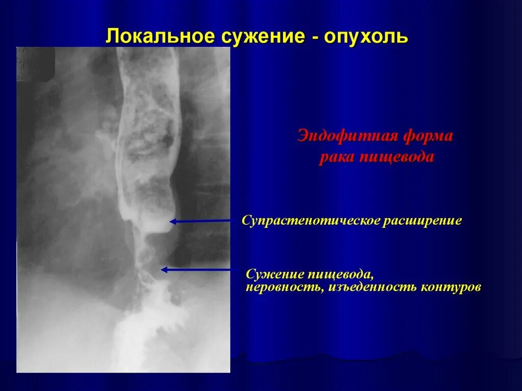 Стриктура пищевода рентген. Локальное сужение пищевода. Супрастенотическое расширение пищевода рентген. Стеноз пищевода с супрастенотическим расширением.