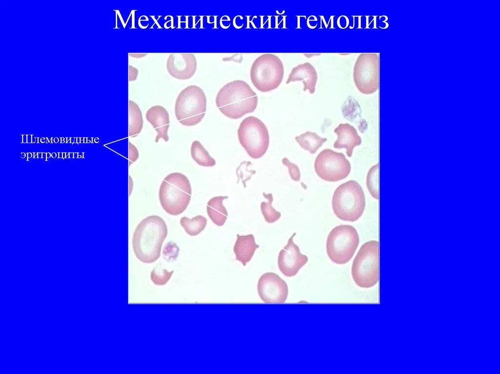 Механический гемолиз эритроцитов. Гемолиз эритроцитов микроскопия. Гемолиз крови мазок. Гемолиз в мазке крови.