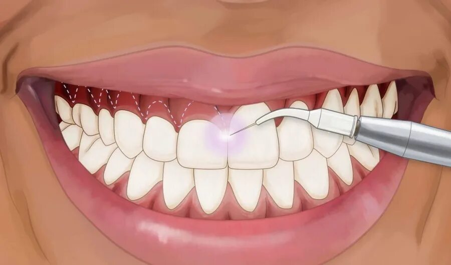 Лазерное сверление зубов. Гингивопластика десневая улыбка. Препарирование лазером. Лазерная коррекция десневой улыбки. Лазерный сколько зуб.