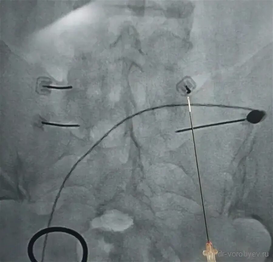 Фасеточная блокада. Радиочастотная денервация фасеточных суставов позвоночника. Радиочастотная деструкция поясничного отдела. Операция радиочастотная денервация фасеточных суставов. Денервация нерва позвоночника.