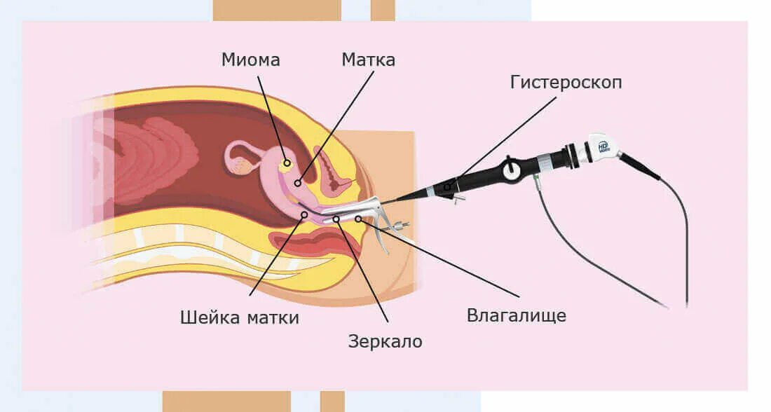 Операция полипы сколько стоит. Гистерорезектоскопия полипа матки. Гистерорезектоскопия и РДВ что это. Лапароскопия и гистероскопия. Гистероскопия маточных труб.