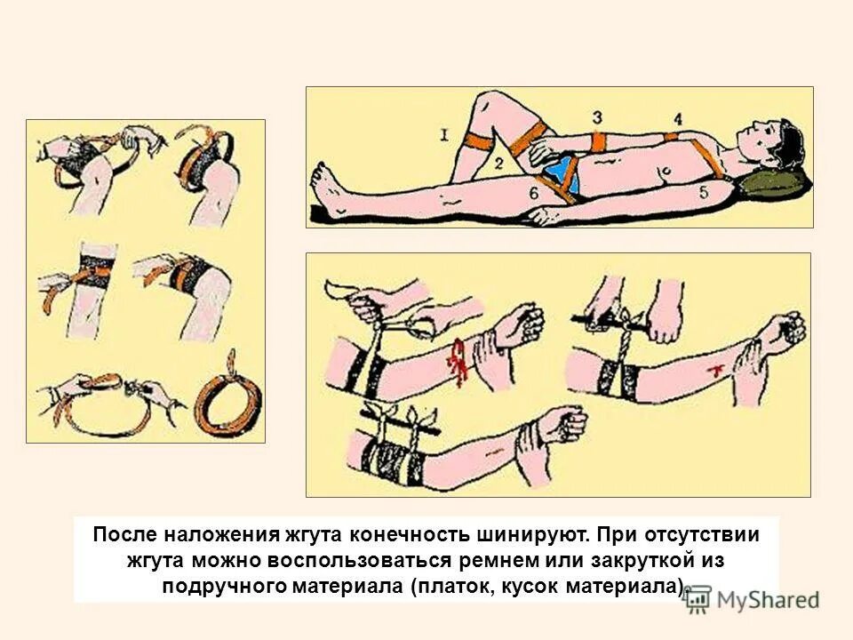 Наложение кровоостанавливающий жгут. Наложение артериального кровоостанавливающего жгута. наложения кровоостанавливающего жгута при кровотечении. наложение кровоостанавливающего жгута на конечность. наложение жгута для остановки кровотечения.