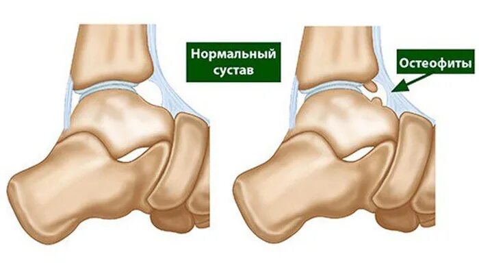 Остеофиты что это такое и как лечить. Остеофит ладьевидной кости. Остеофиты голеностопного сустава. Остеофиты коленного сустава.