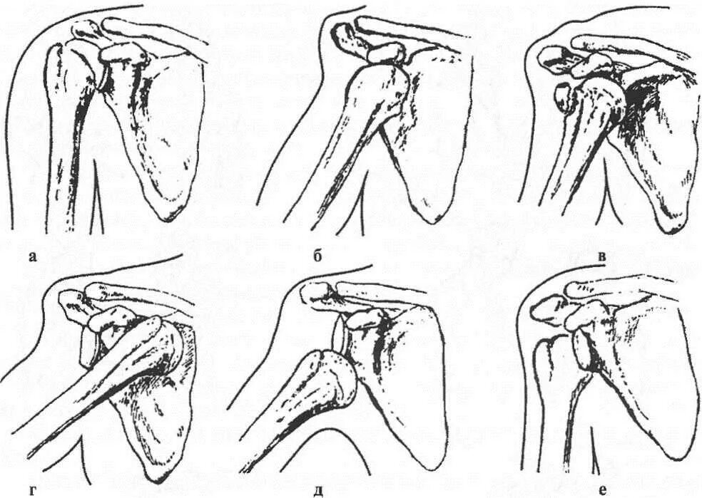 Травматический вывих плеча классификация. Верхний вывих плечевого сустава. Вывих плечевого сустава вправление. Подключичный вывих плеча.