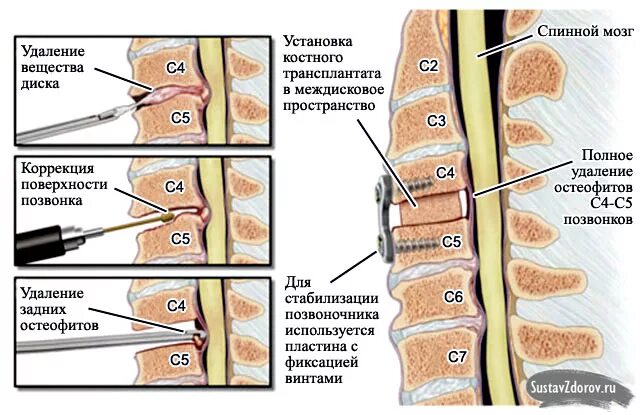 Остеофит симптомы. Остеофиты l3-l5. остеофиты-l2 ,l3, l4. задние остеофиты l4-s1. костные остеофиты l2-s1.