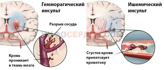 Инсульт состояние человека. Инсульт предынсультное состояние. Симптомы прединсультного состояния. Пред инсулное состояние. Предынсультное состояние симптомы.