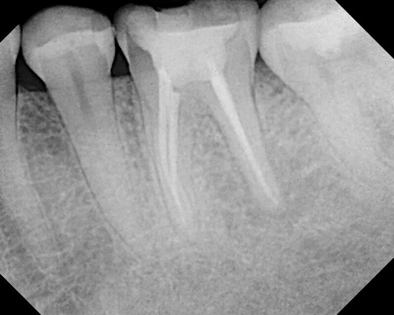 Фиброзный периодонтит. Гранулематозный периодонтит рентген зуба. Хронический апикальный периодонтит рентген. Фиброзный гранулирующий периодонтит рентген. Хронический периодонтит 26 зуба рентгенограмма.