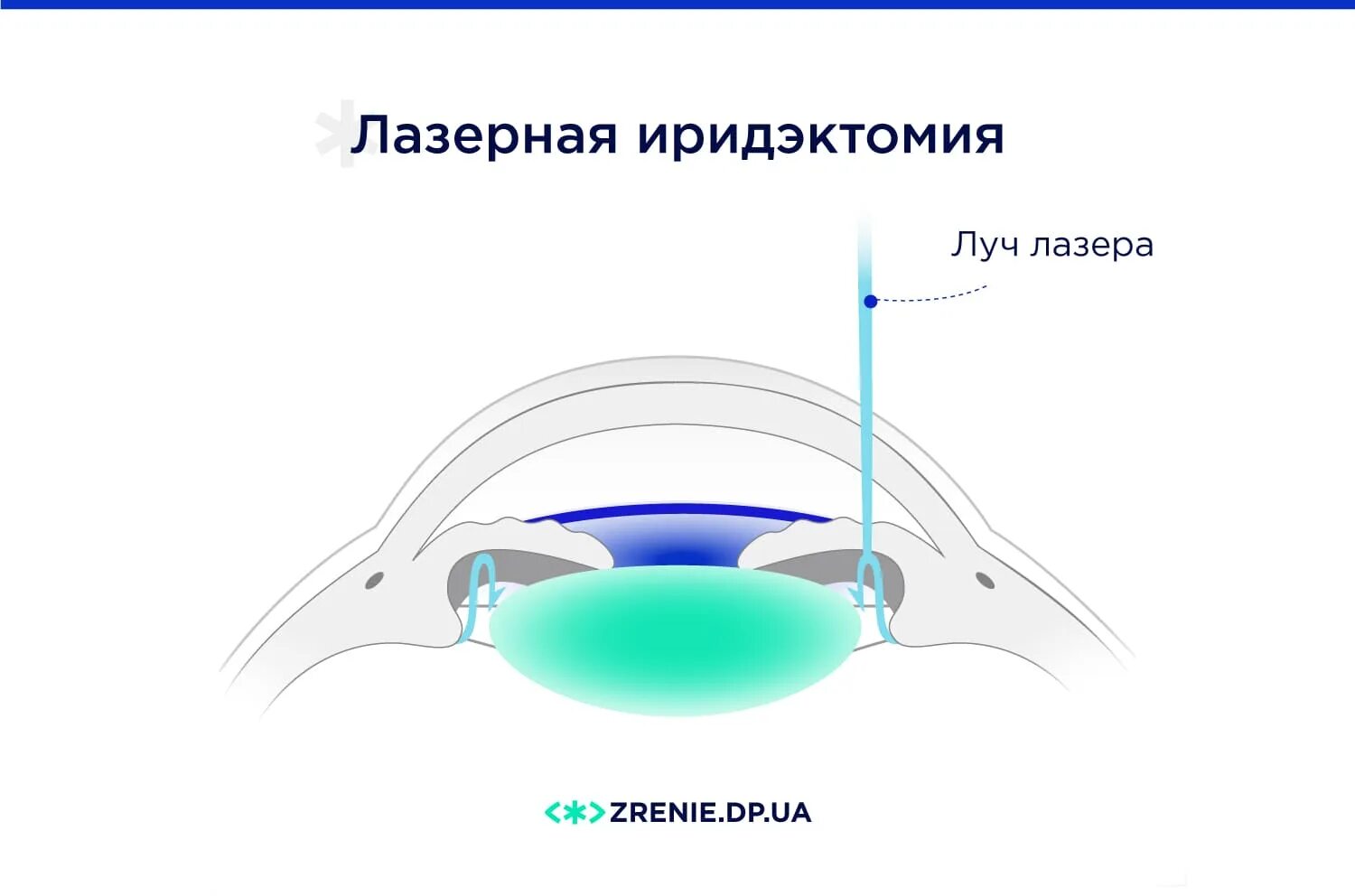 Лазерная иридотомия (иридэктомия). Лазерная иридотомия при глаукоме. Лазерная иридэктомия схема.