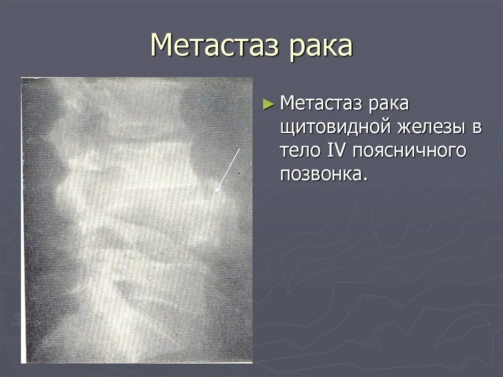 Метастазы при раке щитовидной железы