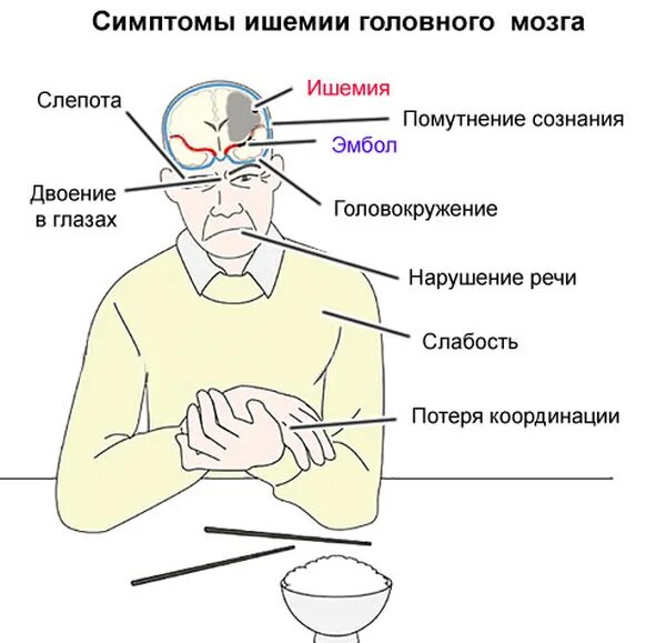 Ишемия 2 стадии. Критерии хронической ишемии головного мозга. Ишемия головного мозга 2 степени симптомы. Подострая ишемия головного мозга. Ишемия головного мозга у взрослых симптомы.